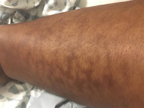 Red Skin Discoloration at Kaitlyn Corkill blog
