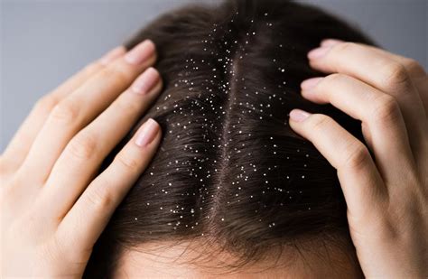 dandruff types  treatments  easy guide