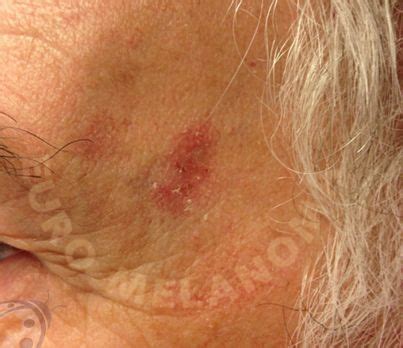 Types of skin cancer - Basaliom - Euromelanoma