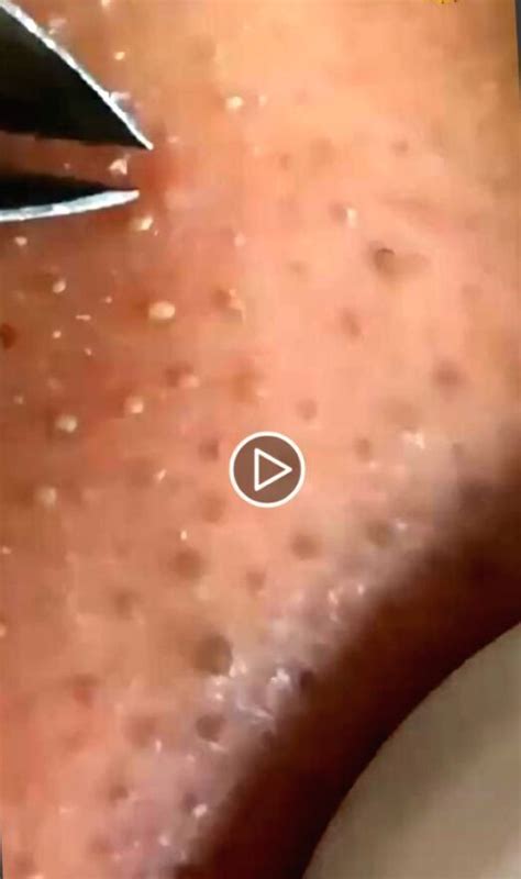 The Worst Of The Worst Gigantic Blackheads On Nose Exposed