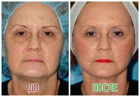 Подтяжка лица после похудения операция - фото презентация
