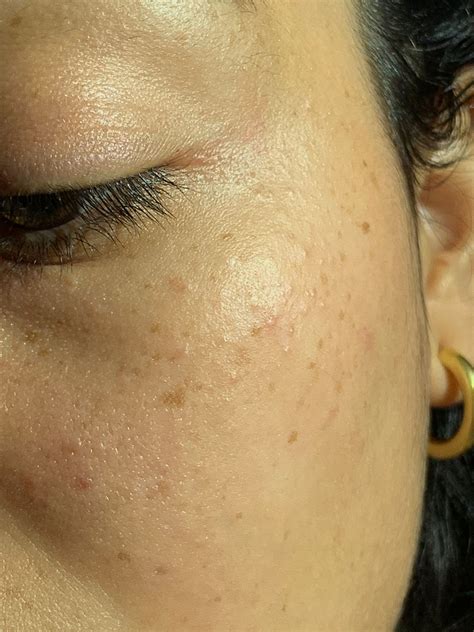 Small Flesh Colored Bumps