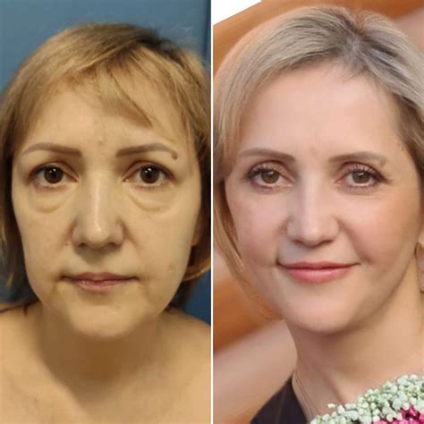 Пластика лица - Пластический хирург - Карапетян Георгий Эдуардович