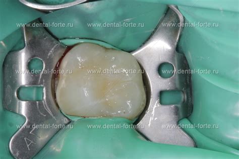Лечение кариеса 26 зуба - Стоматология Набережные Челны - DENTAL FORTE ...