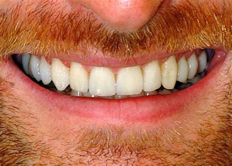 small teeth   fix short  worn smiles   appointment cap