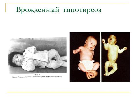 Заболевания эндокринной системы у детей. Гипотиреоз. Надпочечниковая ...