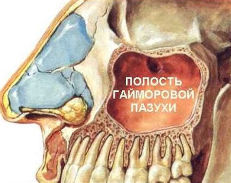 Гайморит. Лечение гайморита любой формы заболевания