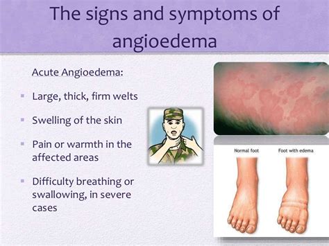 Angioedema