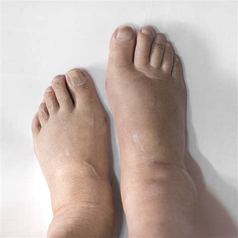 Causes and Treatment of Swollen Feet | Next Step Foot & Ankle Clinic