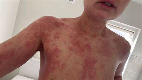 Topical Steroid Withdrawal