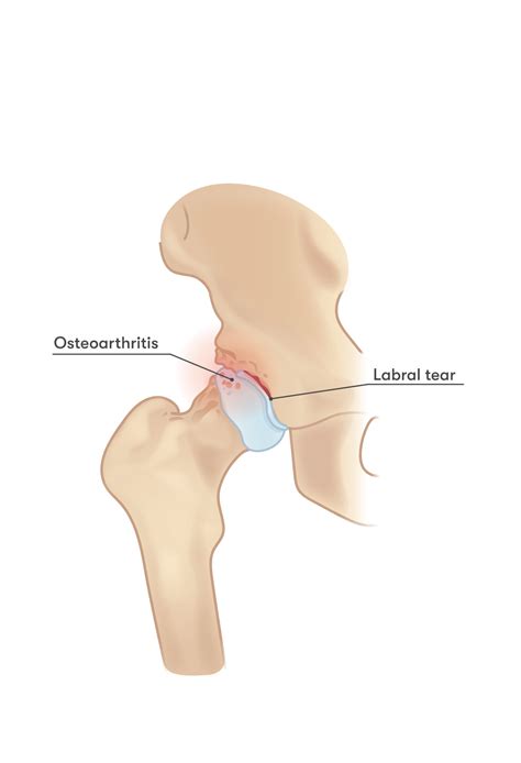 Femoroacetabular Impingement - Injurymap