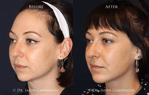 Advanced Radio Frequency Skin Tightening and Lifting Gallery - Dr ...