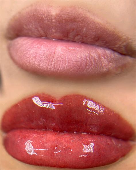 how to remove fordyce spots 8