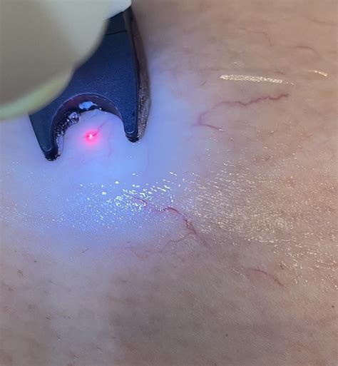 Laser Spider Vein Removal