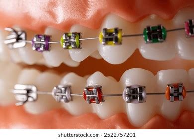 closeup dental braces teeth straightening stock photo