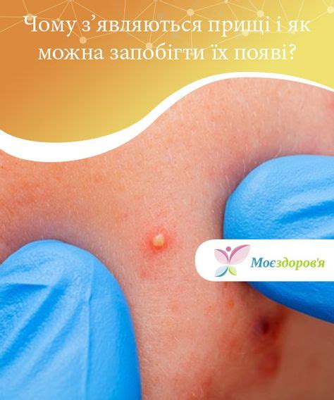 Чому з'являються прищі і як можна запобігти їх появі | Красота