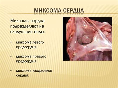 Миксома сердца - презентация онлайн