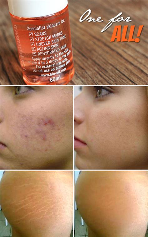 Bio Oil Para Estrias Antes E Depois - Testei: BioOil | Deborah Zandonna