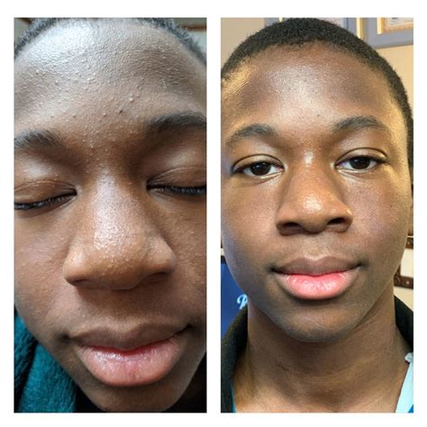 BioAcne Facial - For Acneic Skin - Edwards’ Wellness & Skin Care