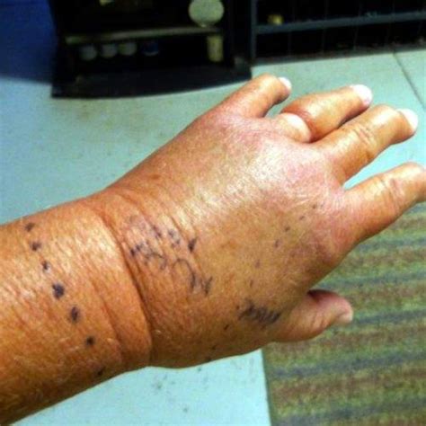 Eastern Diamondback Rattlesnake Bite 