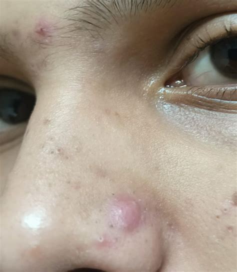 Huge pimple on nose : r/Skincare_Addiction