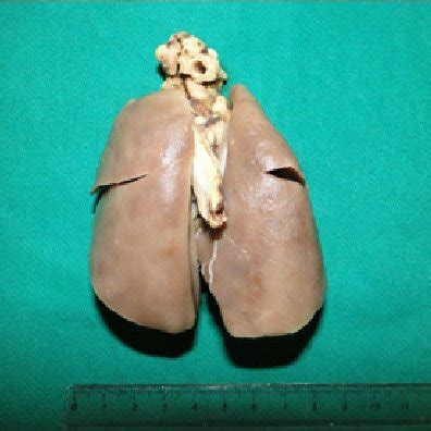 liver tissue diffuse heterogeneous color alteration   tissue