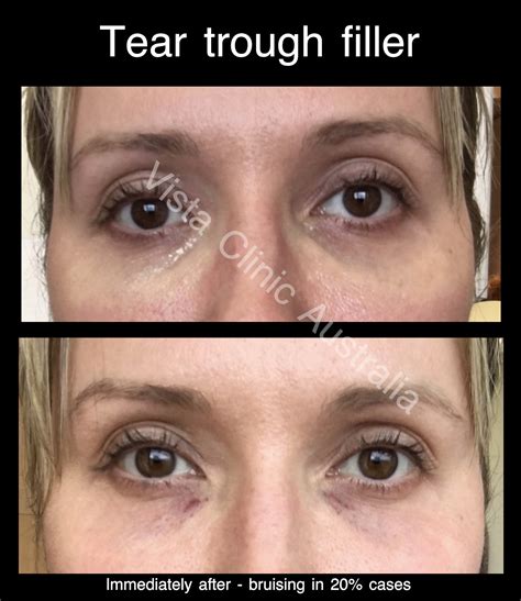 how to fix sunken eyes