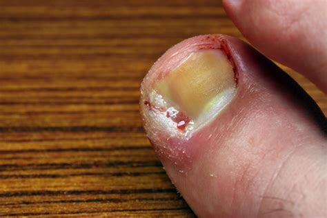 Ingrown Toenail Treatment | CarePlus Foot and Ankle Specialists