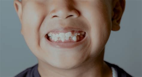 hyperdontia   dental condition   affect  teeths alignment