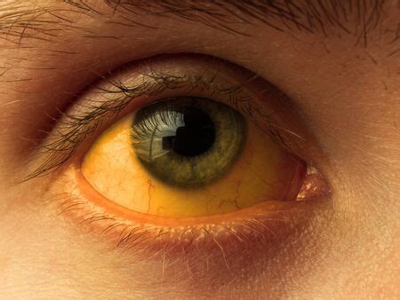 Photo of yellow staining of the sclera - ID:146579608 - Royalty Free ...