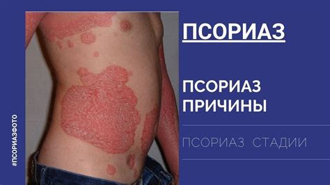 Псориаз. Псориаз кожи. Псориаз причины. Псориаз фото. Стадии псориаза ...