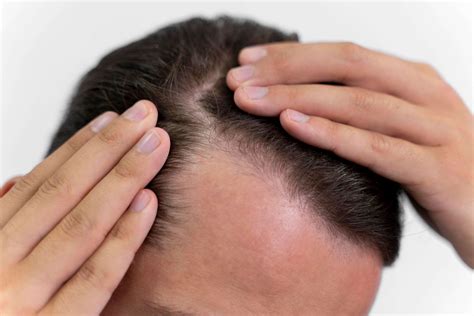 how to stop hair fall for men