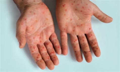 Home Ministry focusing on 4 main entry points for mpox monitoring