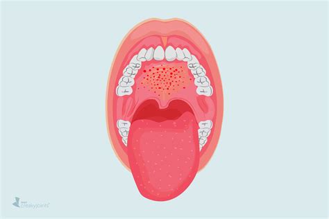 Oral Petechiae