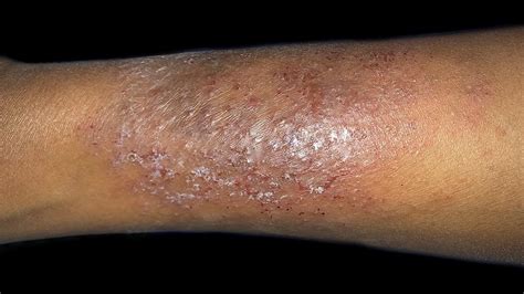 Eczema On Legs Black People Eczema | Eczema In Skin Of Color