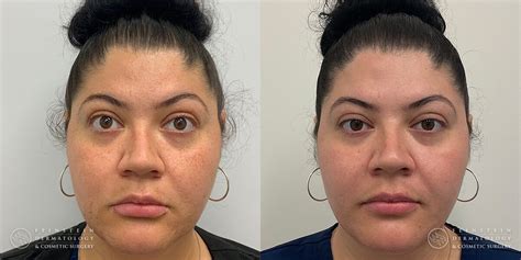 Forever Young® BBL + HALO® Laser | Feinstein Dermatology