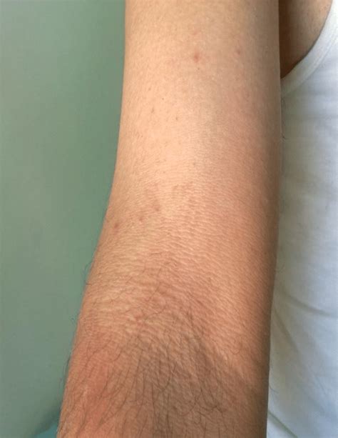 Pityriasis Versicolor