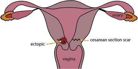 Schematic diagram of a cesarean section scar ectopic pregnancy ...