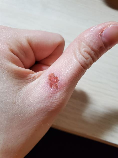 Does this look like a Staph Infection, or just a regular healing scab ...
