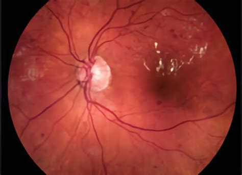 Nonproliferative Diabetic Retinopathy | Retinal Consultants Medical Group