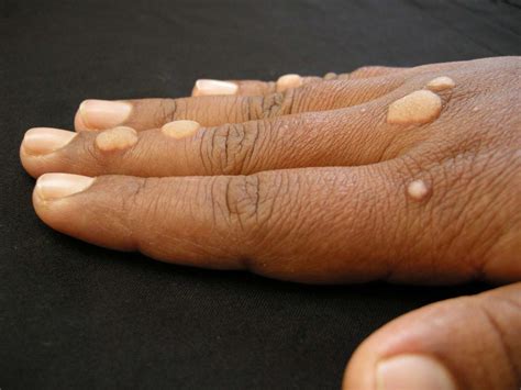 Skin Infections: Types, Symptoms, Pictures, & Treatment