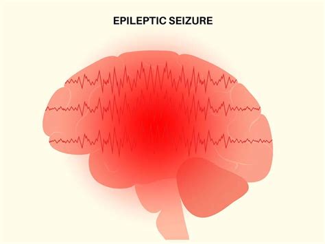 All About Epilepsy In Children: Causes, Types, Diagnosis and Treatment ...