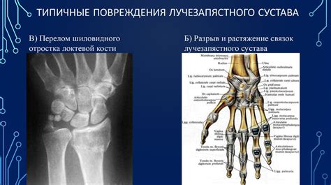 Повреждения лучезапястного сустава - презентация онлайн