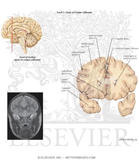 Coronal Sections Through the Forebrain: Genu of Corpus Callosum