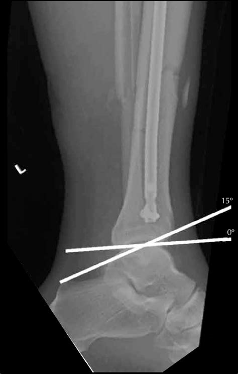 0º (orthogonal) and 15º (craniocaudal angulation) orientations of the ...