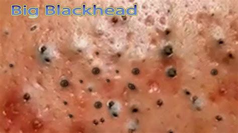 blackhead acne removal  face youtube