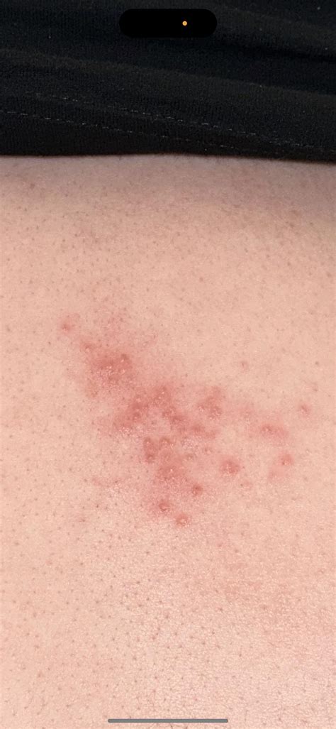 Topical steroid withdrawal? Embarrassing rash : r/DiagnoseMe
