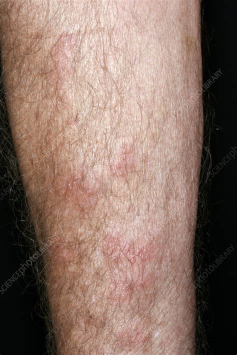 Shingles rash - Stock Image - C058/2424 - Science Photo Library