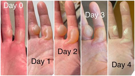 degree burn blister treating burns scalds  important