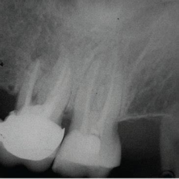 Periapical image of tooth 46 showing little furcal radiolucency (Case 1 ...
